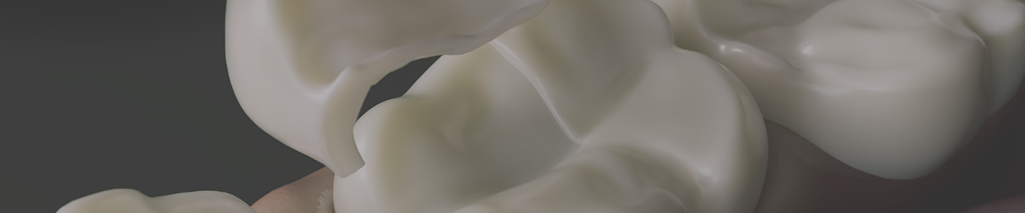 Dental Inlays and Onlays in Plano, TX | Imagecare Dental Group