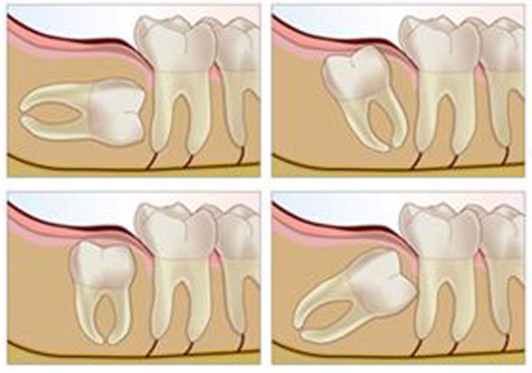 Wisdom Teeth Diagram Wisdom Teeth Removal Phoenix AZ Tooth Wisdom Teeth Diagram Wisdom Teeth Removal Phoenix AZ Tooth