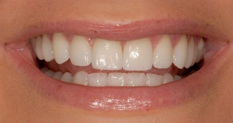 after porcelain veneers